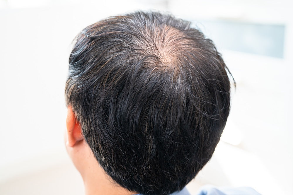 Hair Loss in Your 20s: Causes, Solutions, and Prevention