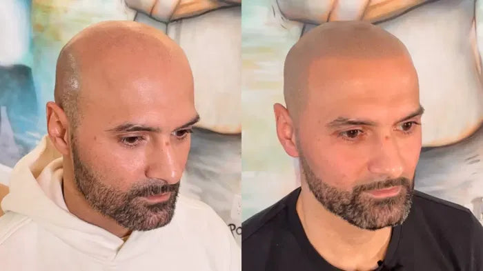 before and after SMP procedure
