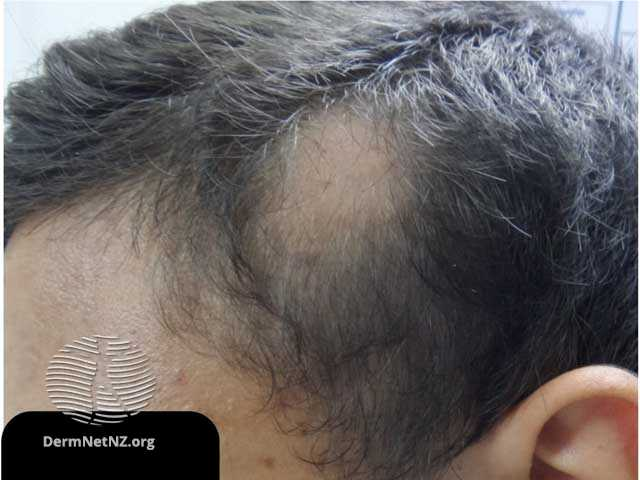Alopecia Areata: Causes, Symptoms, and Treatment Options