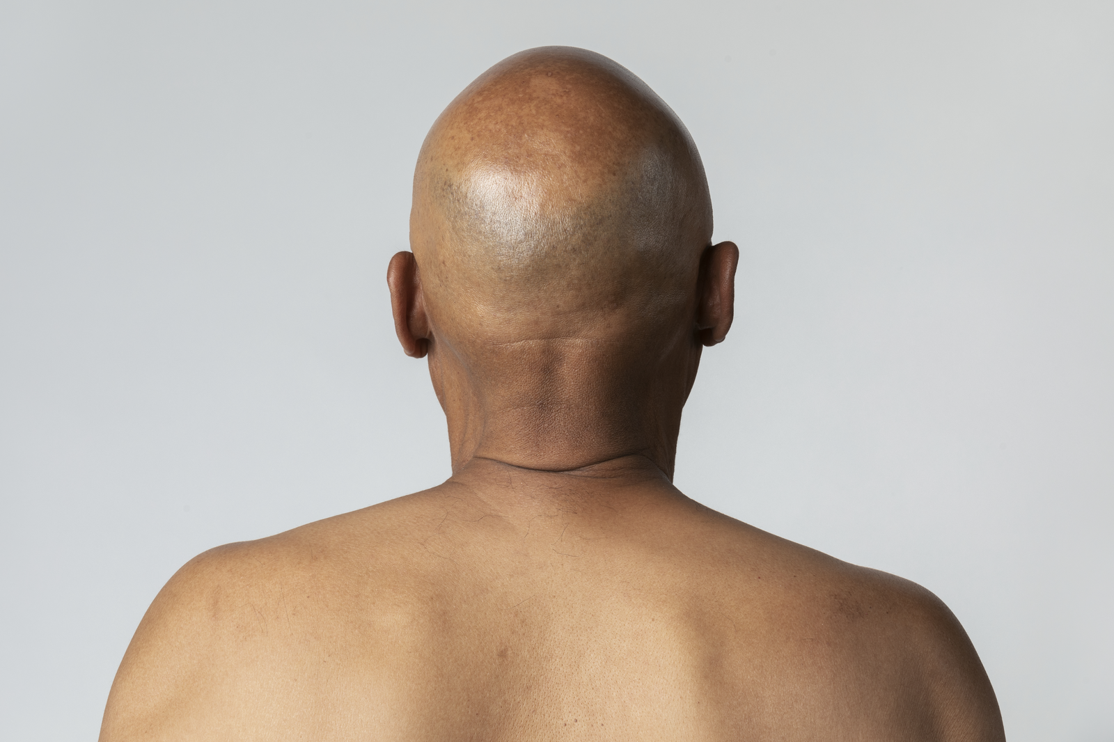 How to Treat & Prevent Dry Scalp on Bald Heads