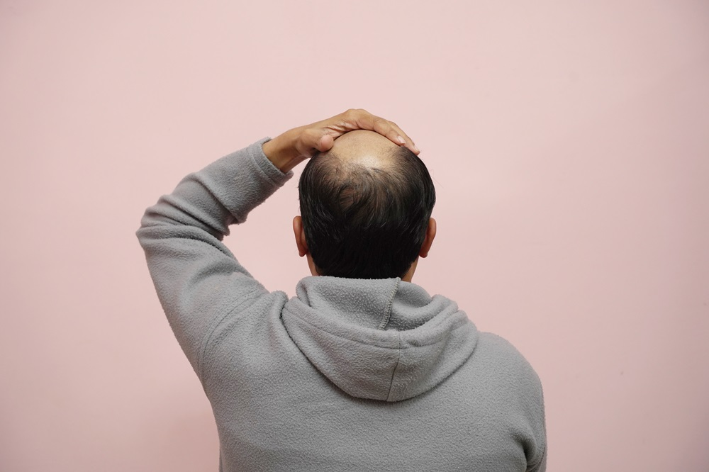 Bald On Top, Hair On Sides? Here's What to Do