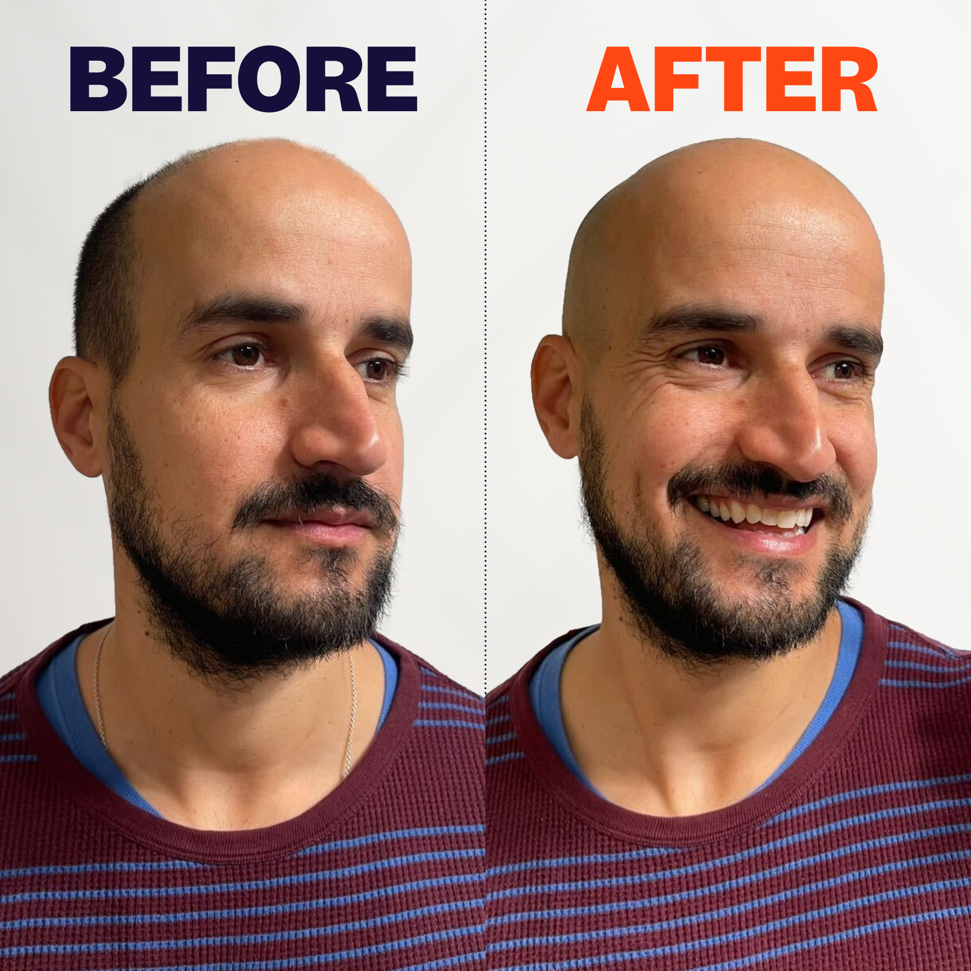 Man before and after using the Freebird FlexSeries® Pro Shaving Kit, looking happier in the after image.